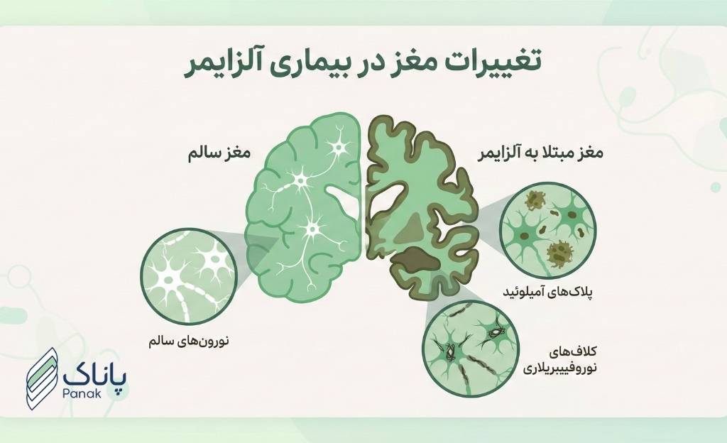 آلزایمر چیست؟